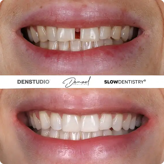 CBBaOne, Teeth Straightening, Composite Bonding