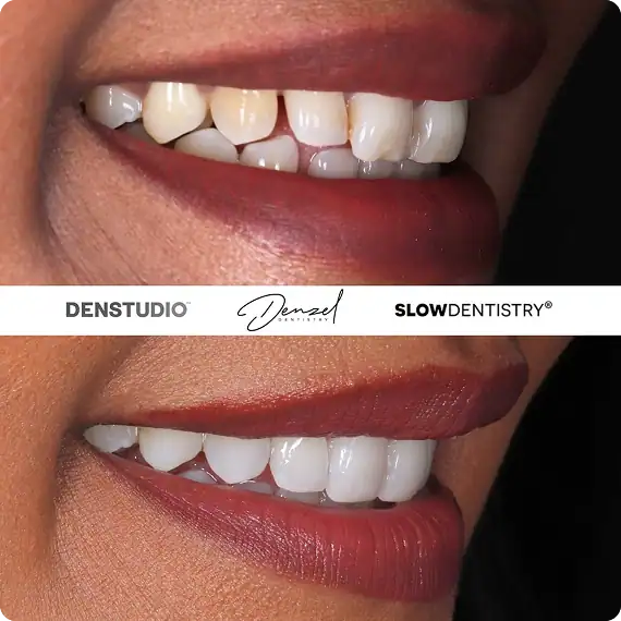CBBaSix, Teeth Straightening, Composite Bonding